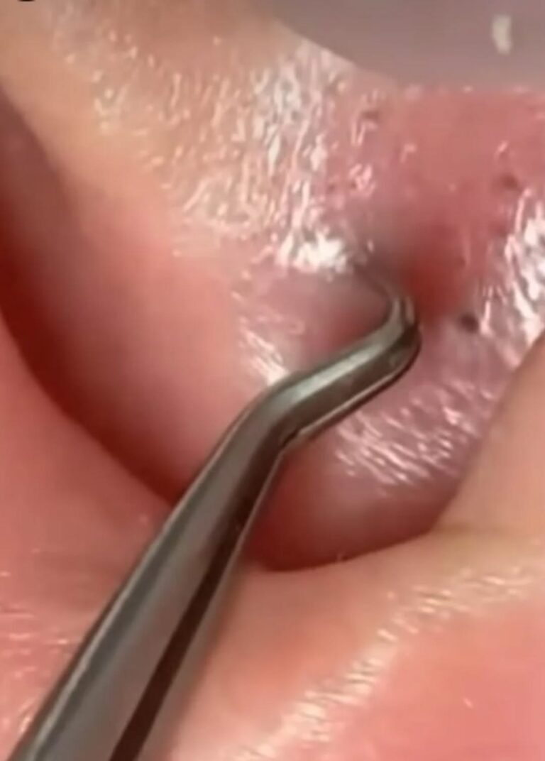 Best 15 Tips For Squeezing Blackheads On Nose
